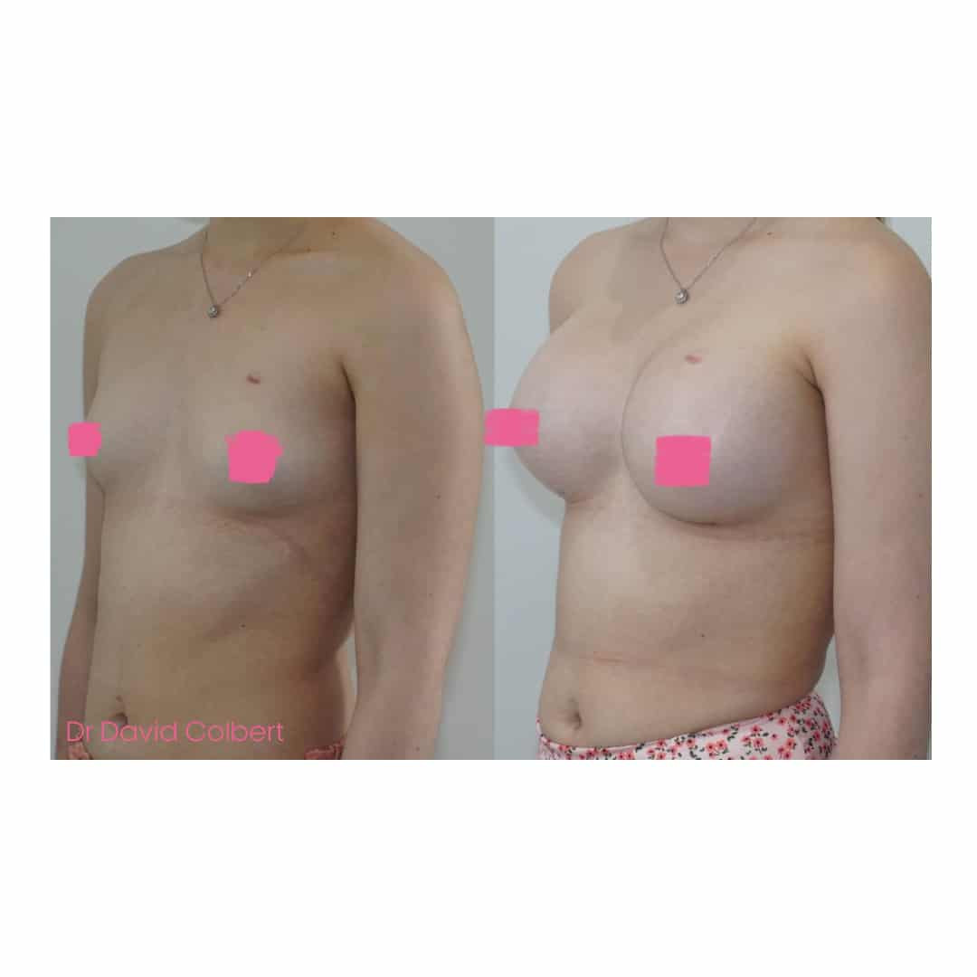 Is There a Right Way to Choose Breast Implant Size? - David